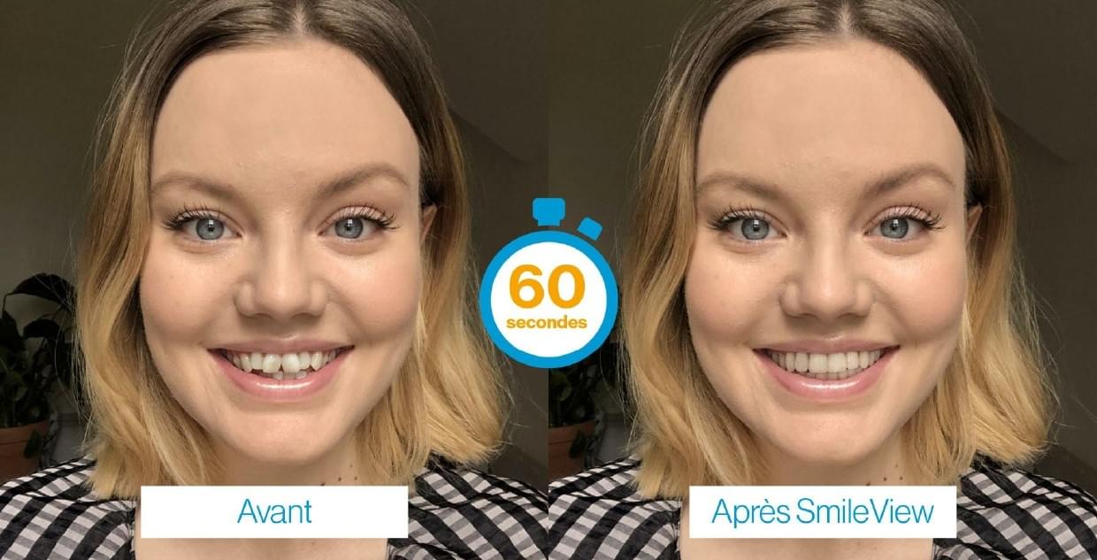 photo avant/après invisalign smileview